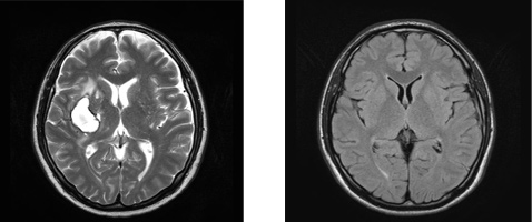 脳神経外科MRI画像